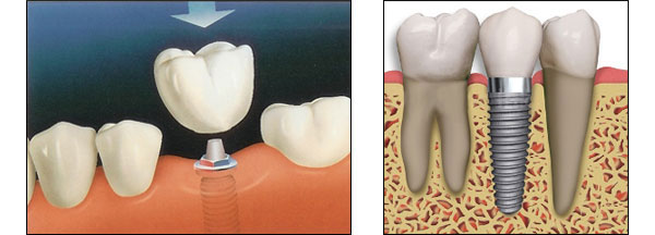 Camarillo Dental Implants Dentists